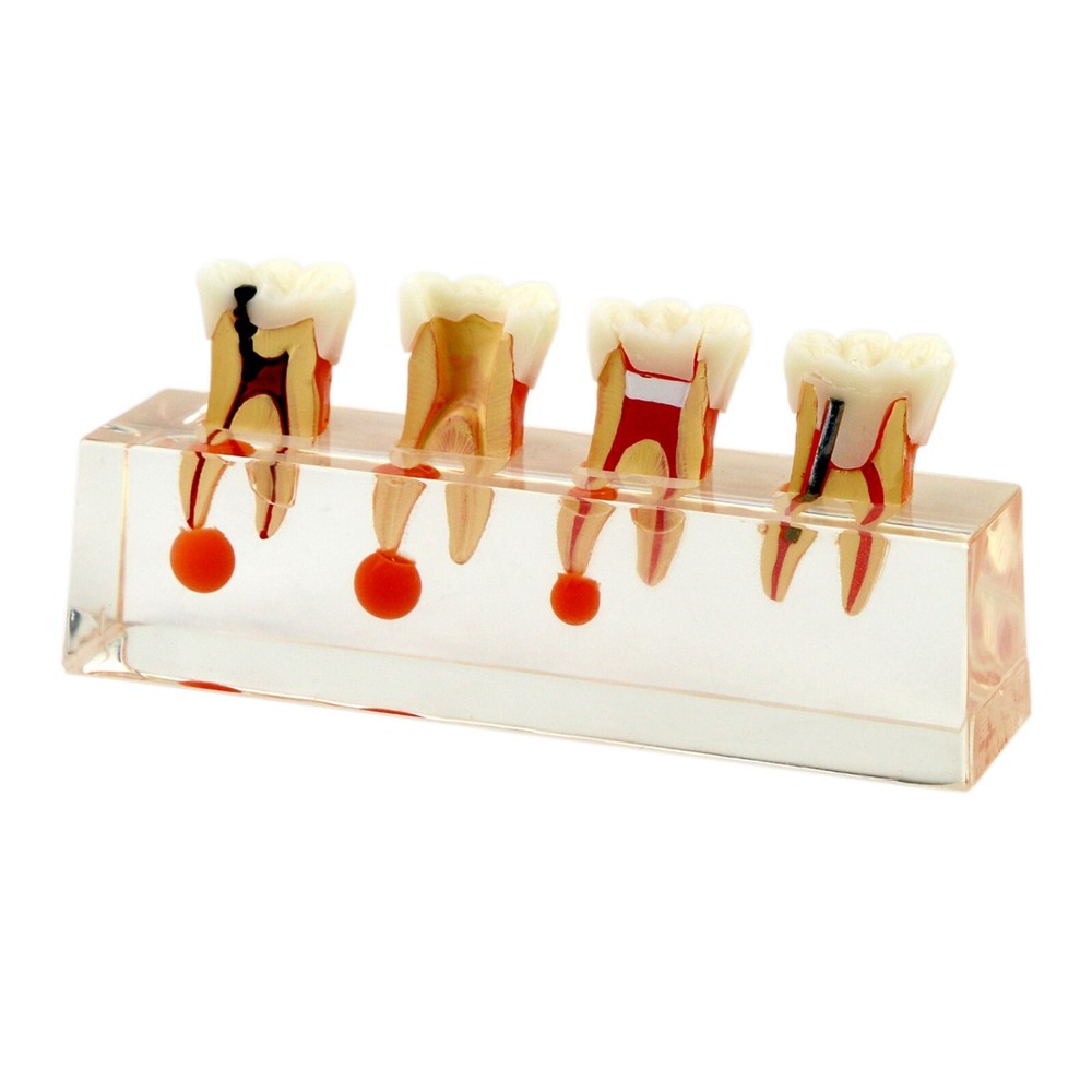 Dental Teeth Model 4 Stage Endodontic Treatment Demonstrates Study Model#4018
