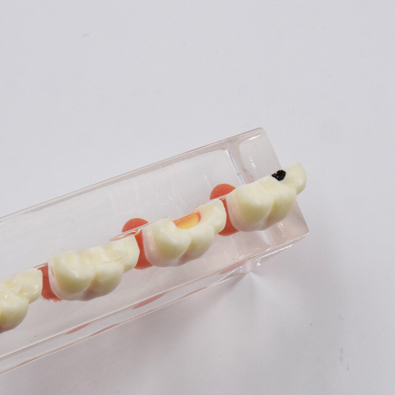 Dental Caries Disease M4018 Study Teaching Model Tooth Correcting Malocclusion