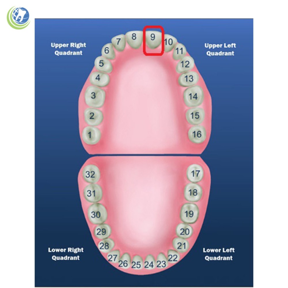 DENTAL POLYCARBONATE TEMPORARY CROWNS #102 (ULC) UPPER LEFT CENTRAL 5/PACK