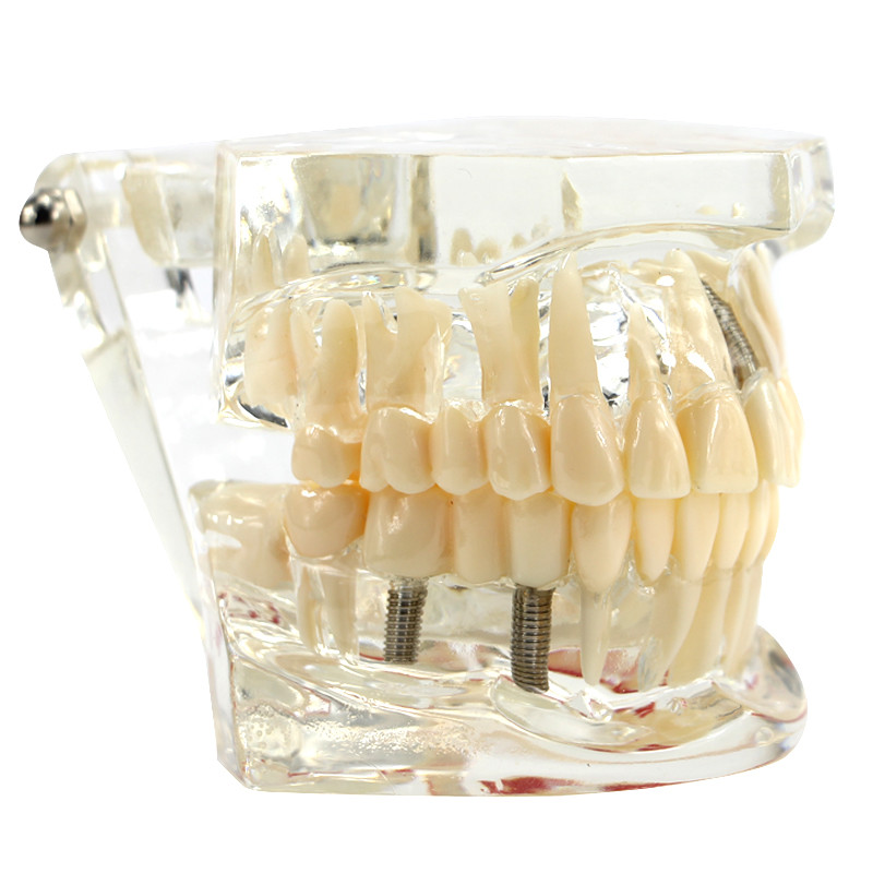 Dental Implant and Restoration Model Transparent Pathological Teeth Study Model