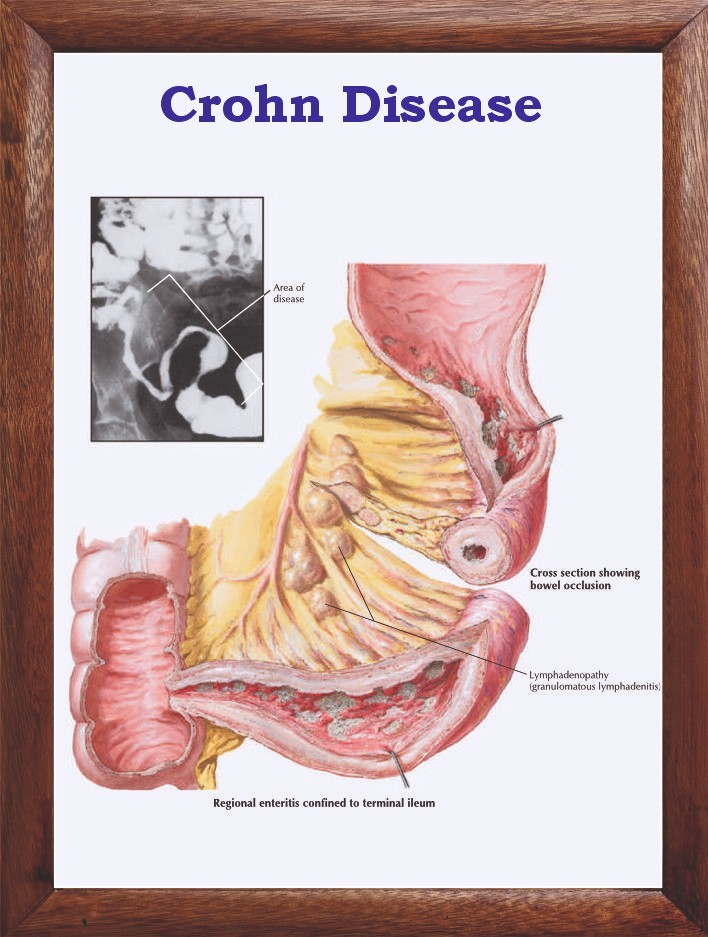 Crohn Disease Chart 12x18 inches