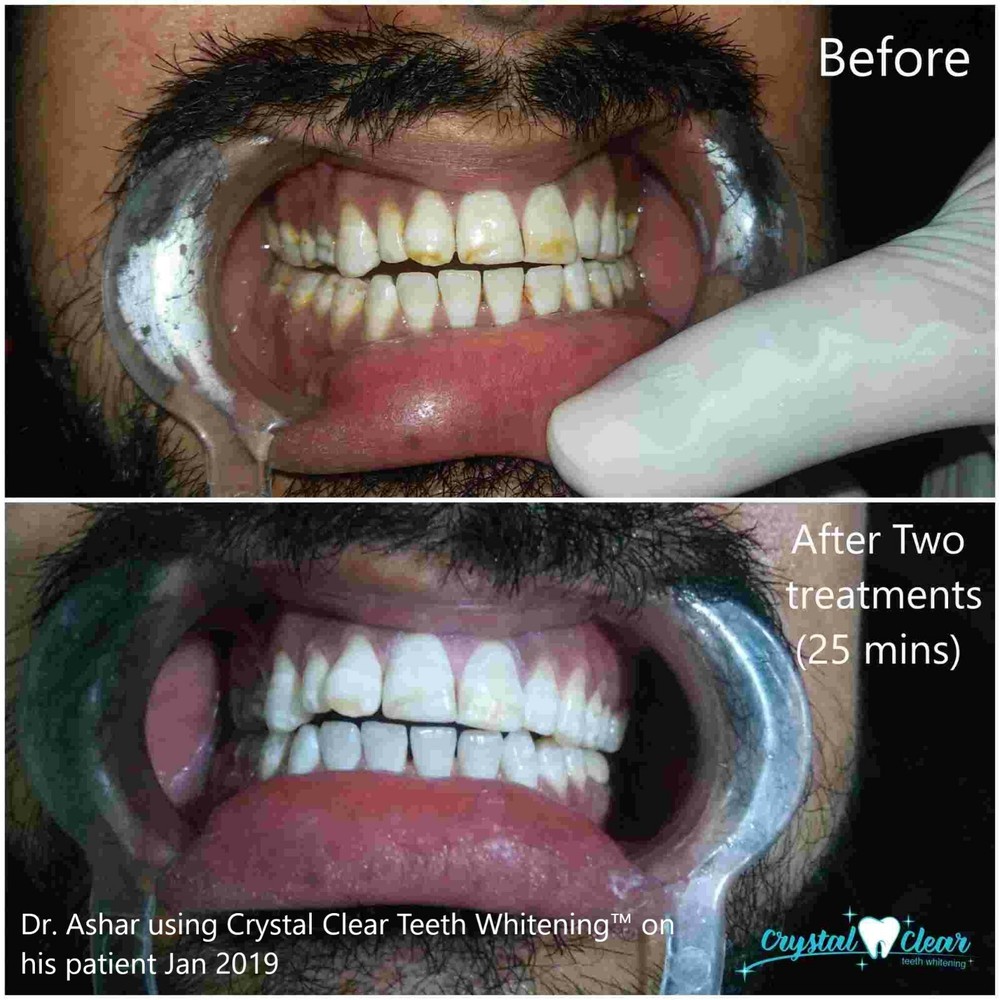 blanqueador de dientes. gel blanqueador de dientes