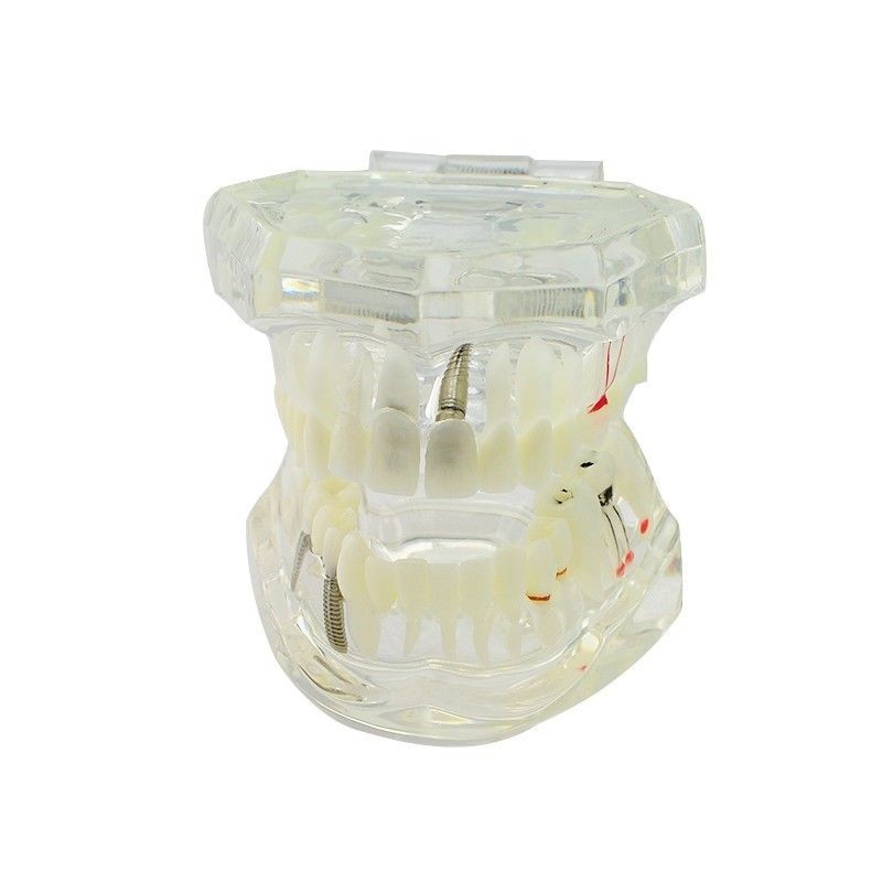 4 Pcs 4 Sizes Dental Restoration Model Implant Pathological Disease Teeth Study