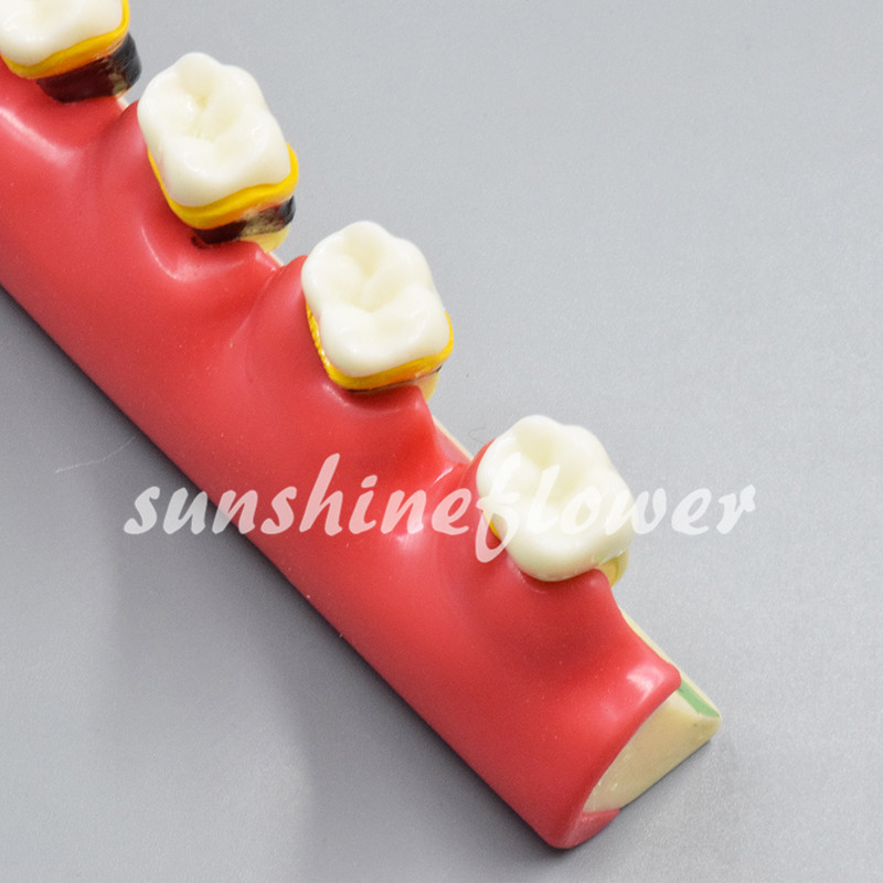 Dental Lab Periodontal Disease Assort Tooth Typodont Study Teaching Teeth Model