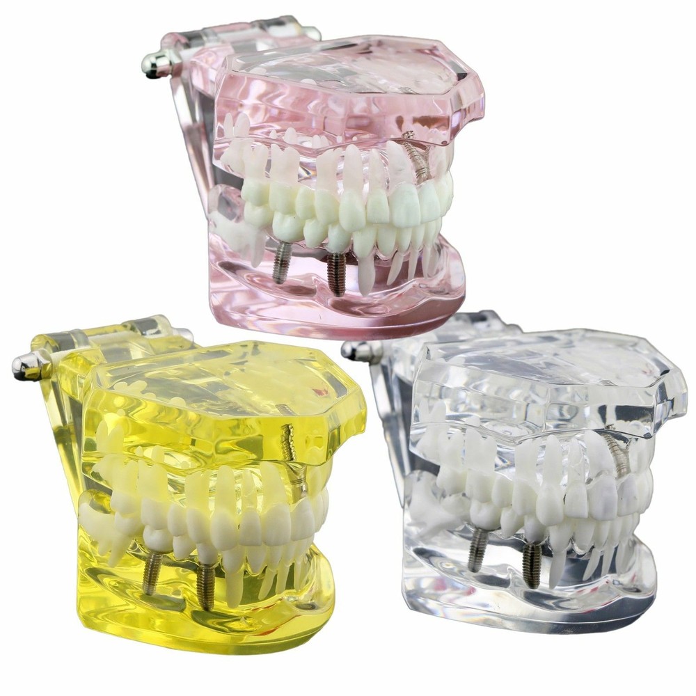 Dental Teeth Model Implant Study Demonstration Restoration Bridge Pathology
