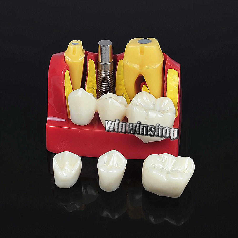 Dental Implant Analysis Crown Bridge Demonstration Teeth Model Remove Teach Lab