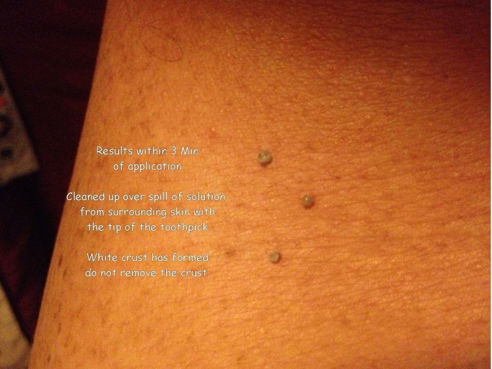 10ml Mole Wart and Skin Tag Remover