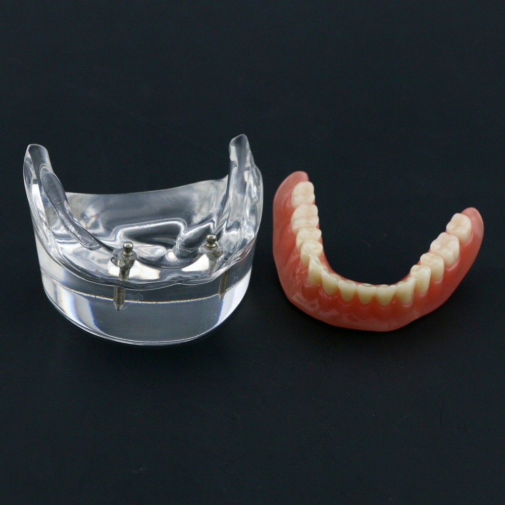 Dental Oral Transparent Upper Teeth 2/4 Implants Model Overdenture Restoration