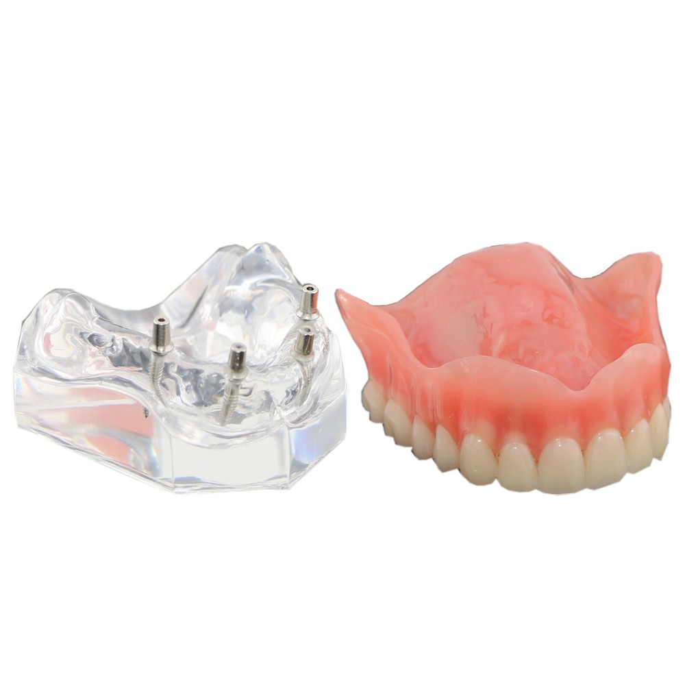 Detal Typondont Restoration Implant Overdenture Teeth Model 2 4 Implants