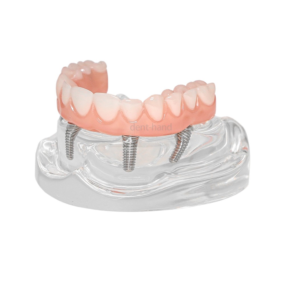 US Dental Overdenture Upper/Lower 4 Implants Demo Teeth Restoration Model