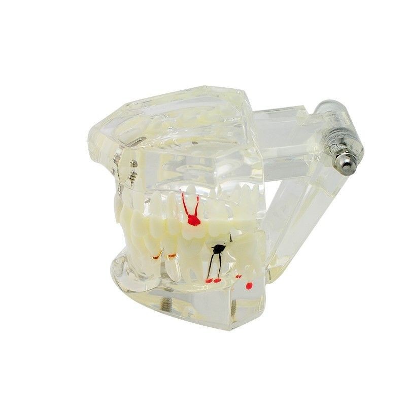 4 Pcs 4 Sizes Dental Restoration Model Implant Pathological Disease Teeth Study