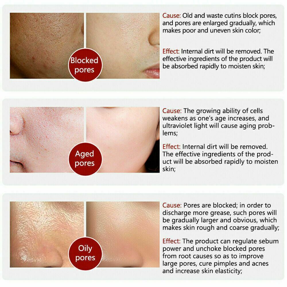 Pore Shrinkage Liquid Remove Blackhead Whitehead Acne Deep Cleansing Whitening