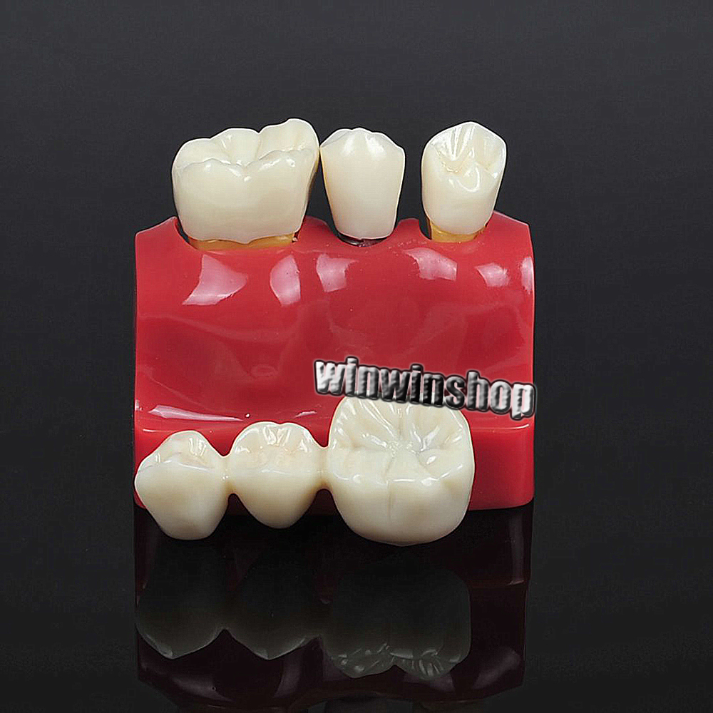 Dental Implant Analysis Crown Bridge Demonstration Teeth Model Remove Teach Lab