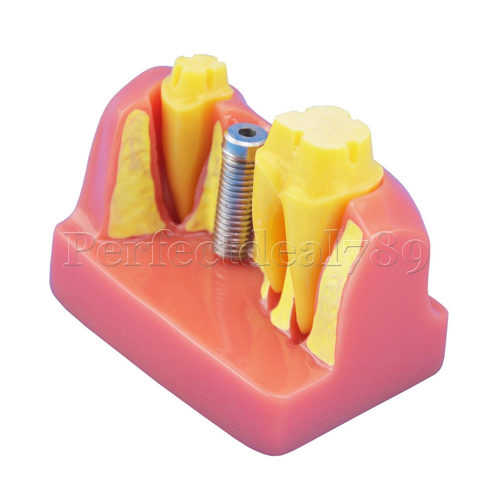 Brand NEW Dental Implant Analysis Crown Bridge Demonstration Study Teeth Model