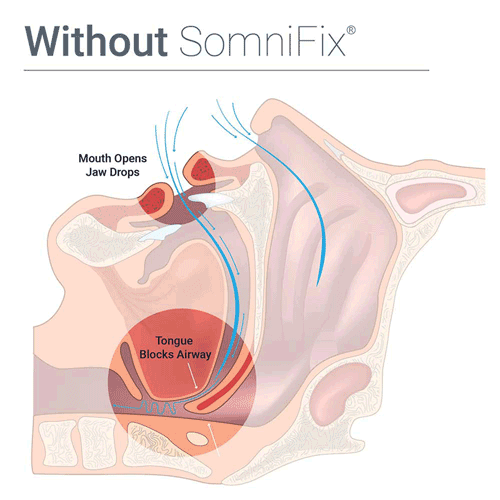 SomniFix ASM11 Sleep Strips for Better Nose Breathing