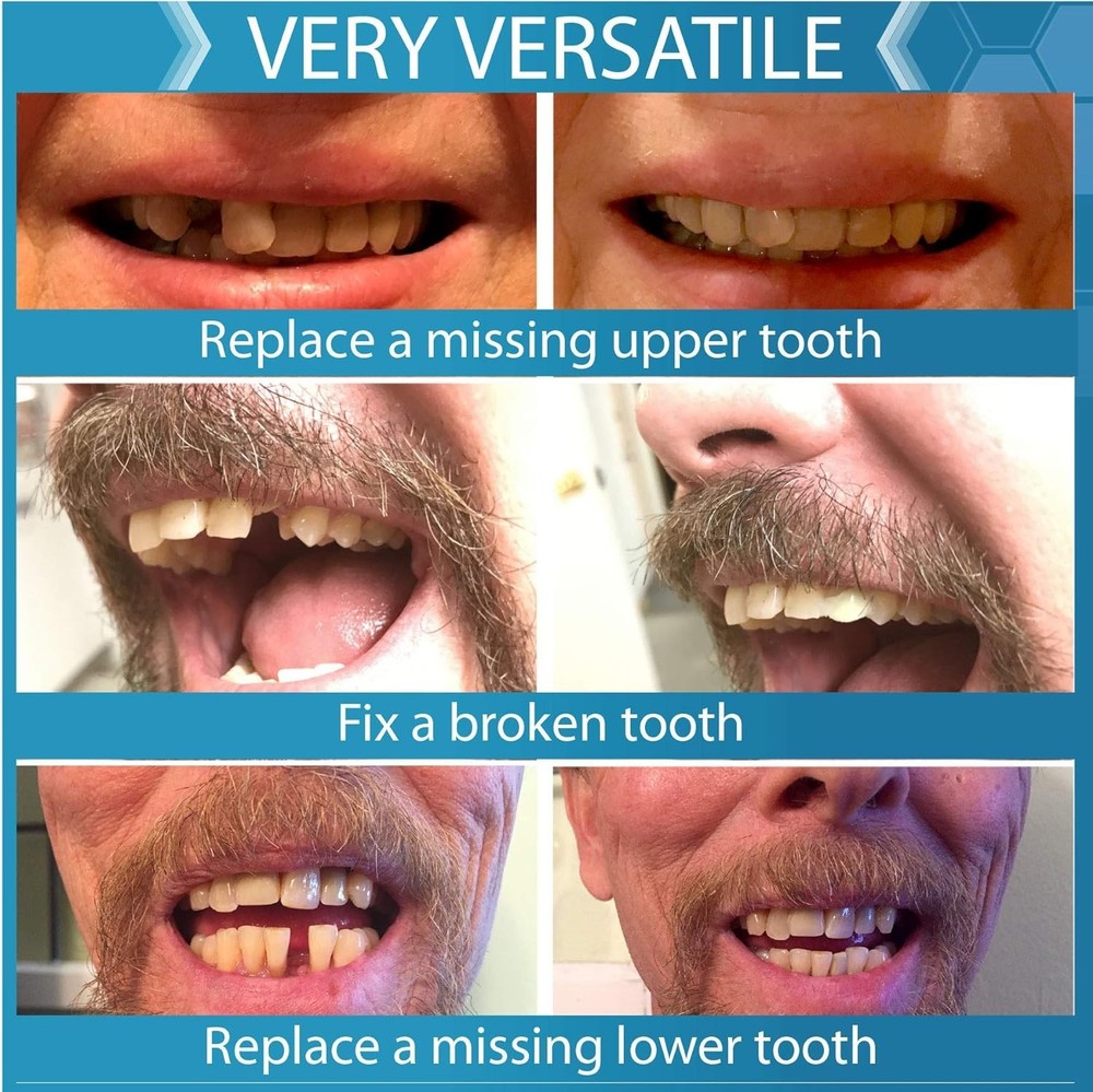 Realistic Tooth Replacement Kit - Replace Missing Teeth with Ease & Confidence