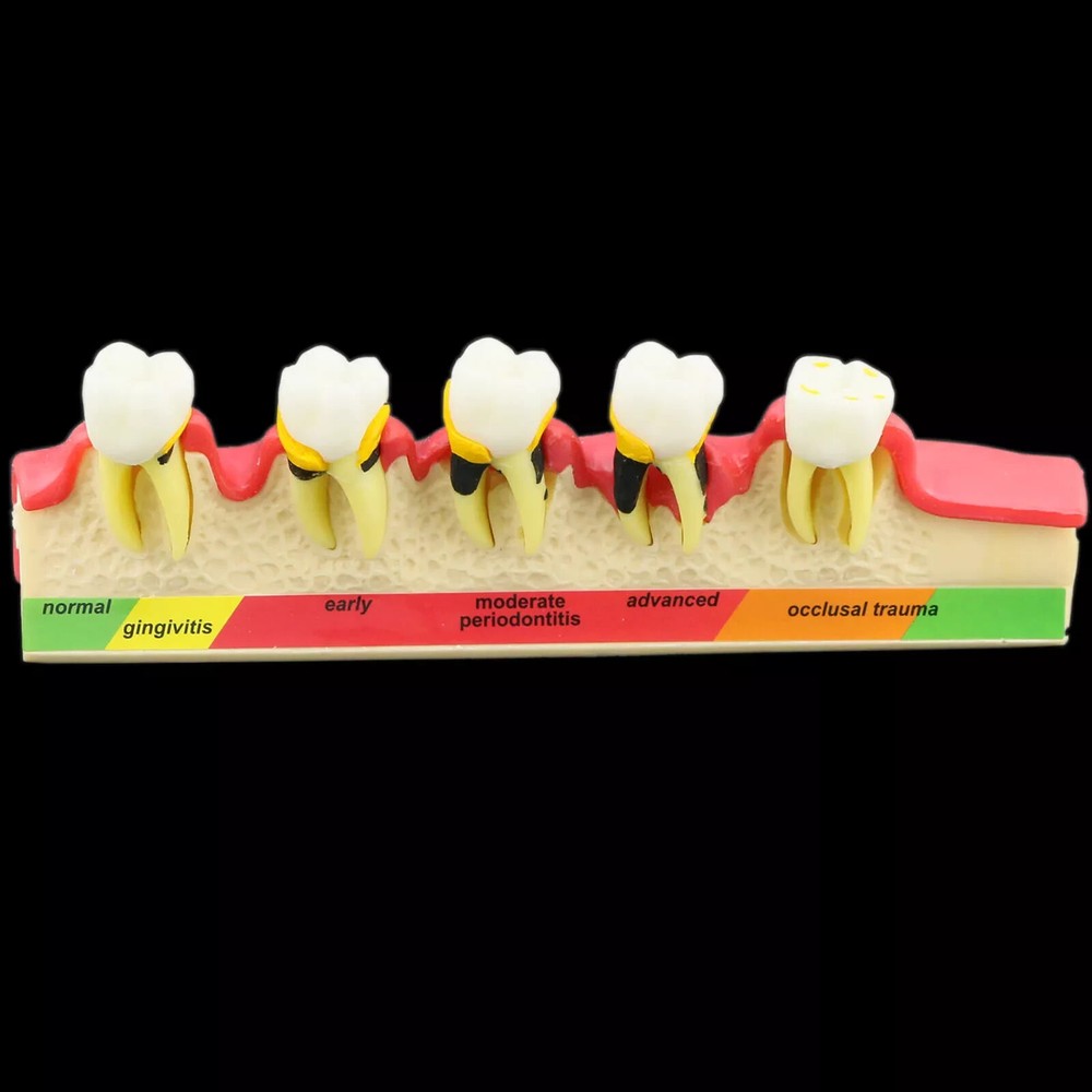 Dental Study Teaching Model Periodontal Disease 5-Stage Teeth Dentoform Typodont