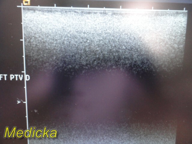 Acuson Model 15L8W Linear Array Ultrasound Transducer Probe ~ 24856