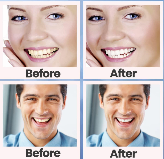 28PCS 5D Teeth Whitening Strips Tooth Rapid Bleaching White Strips Teeth White