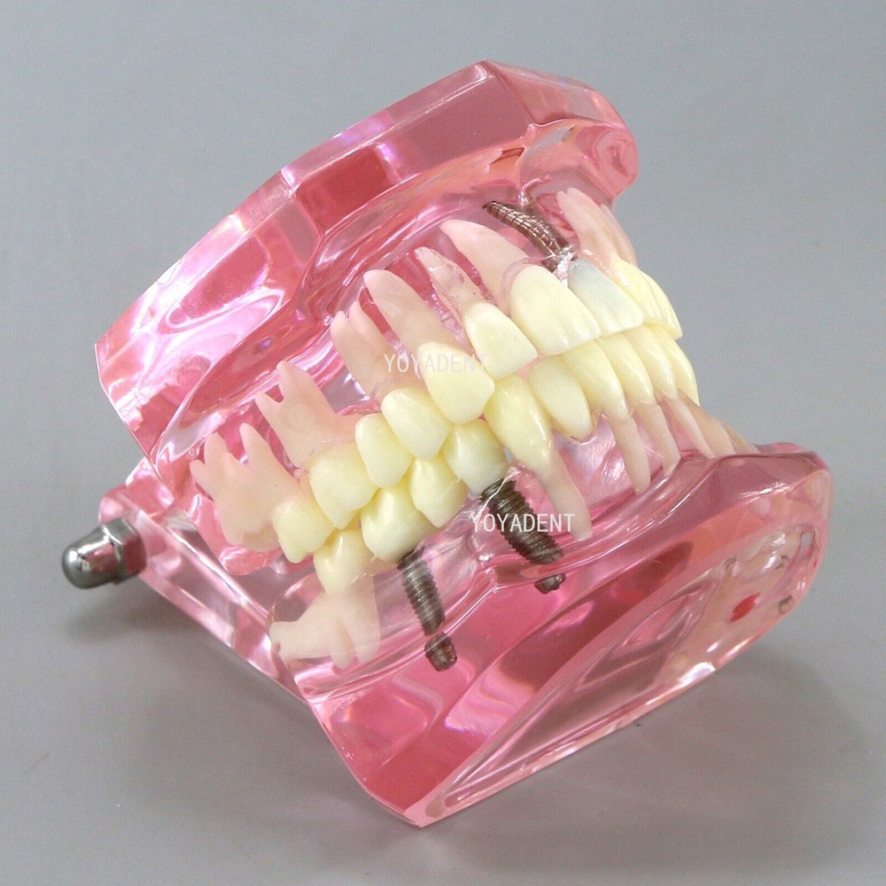 US Dental Teeth Model Ortho Implant Pathological Perio Practice Demo Study Model