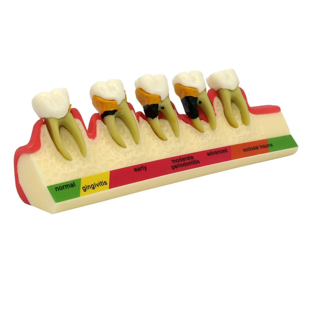Dental Pathological Typodont Teeth Model Periodontics/Implant/Endodontic Caries