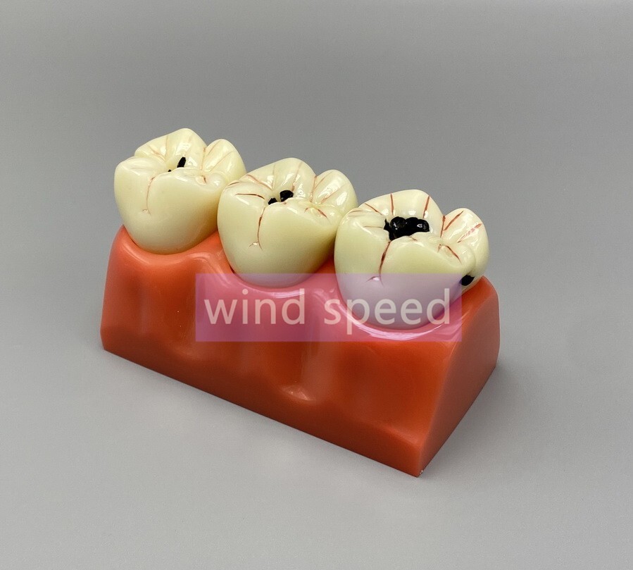 Dental Teaching Model 4 Times Caries Disassembling Comparations Implant Model
