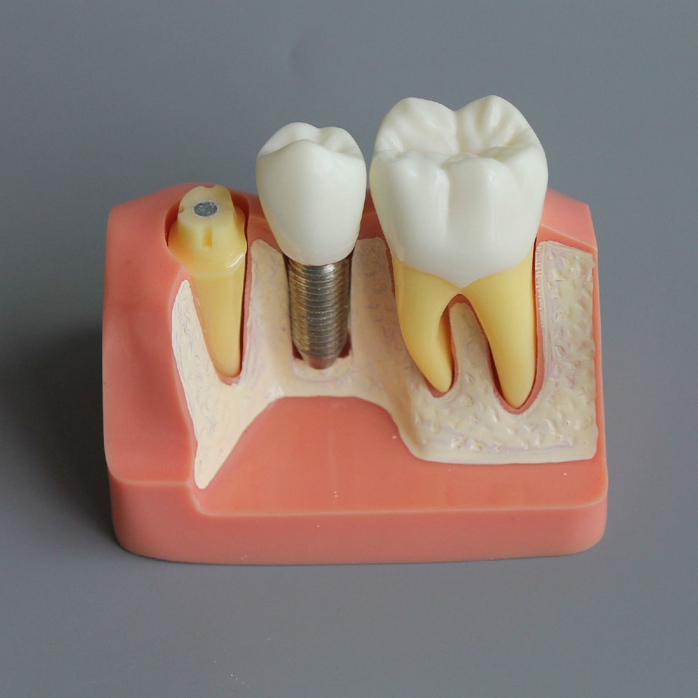 Dental Demonstration Removable Teeth Model Implant Analysis Crown Bridge Study