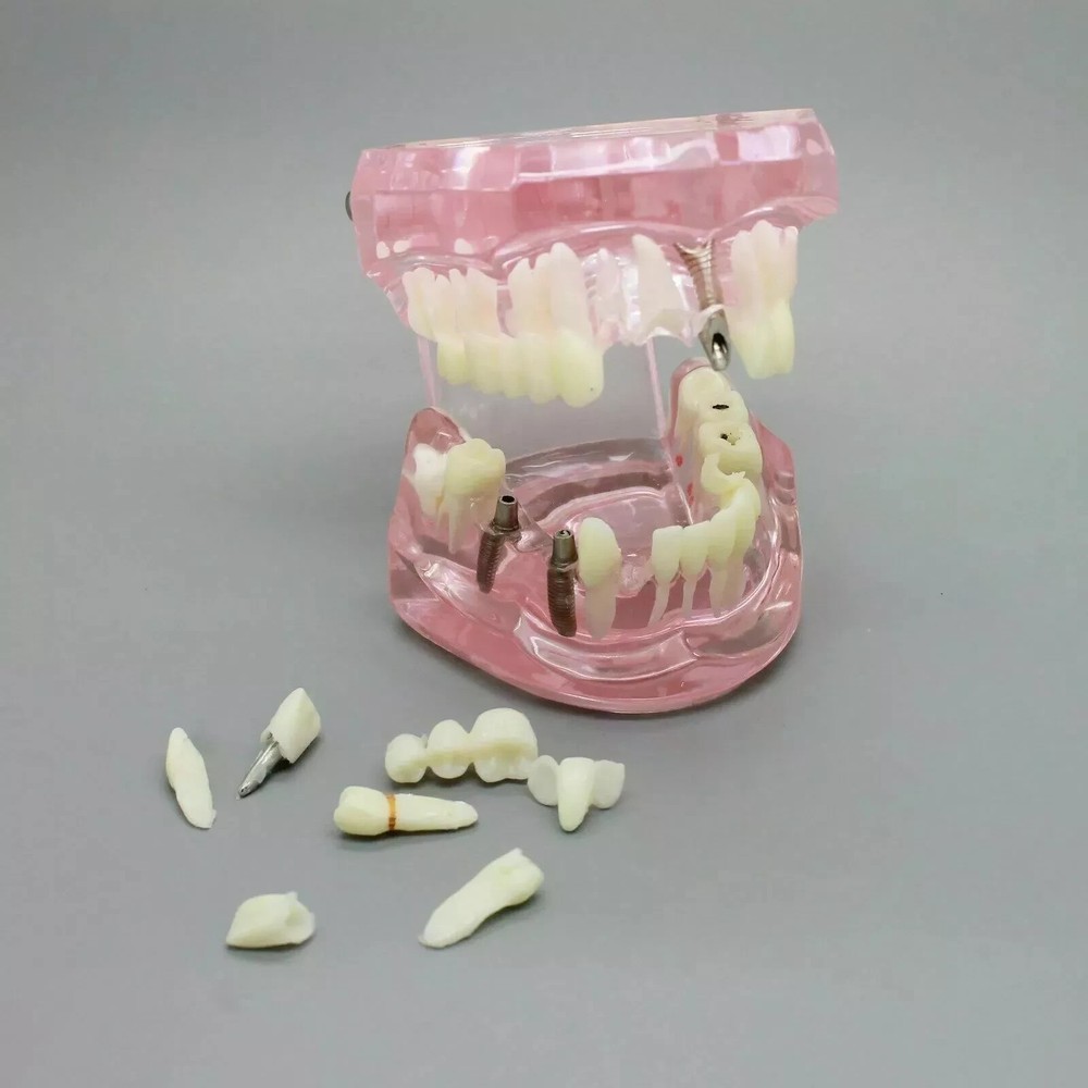 Dental Typodont Teeth Model Ortho Implant Pathological Perio Practice Demo Model