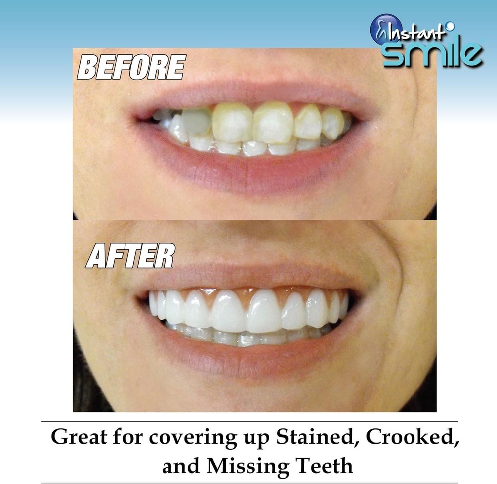 Easy Fitting Cosmetic Veneers - Comfortable Fit