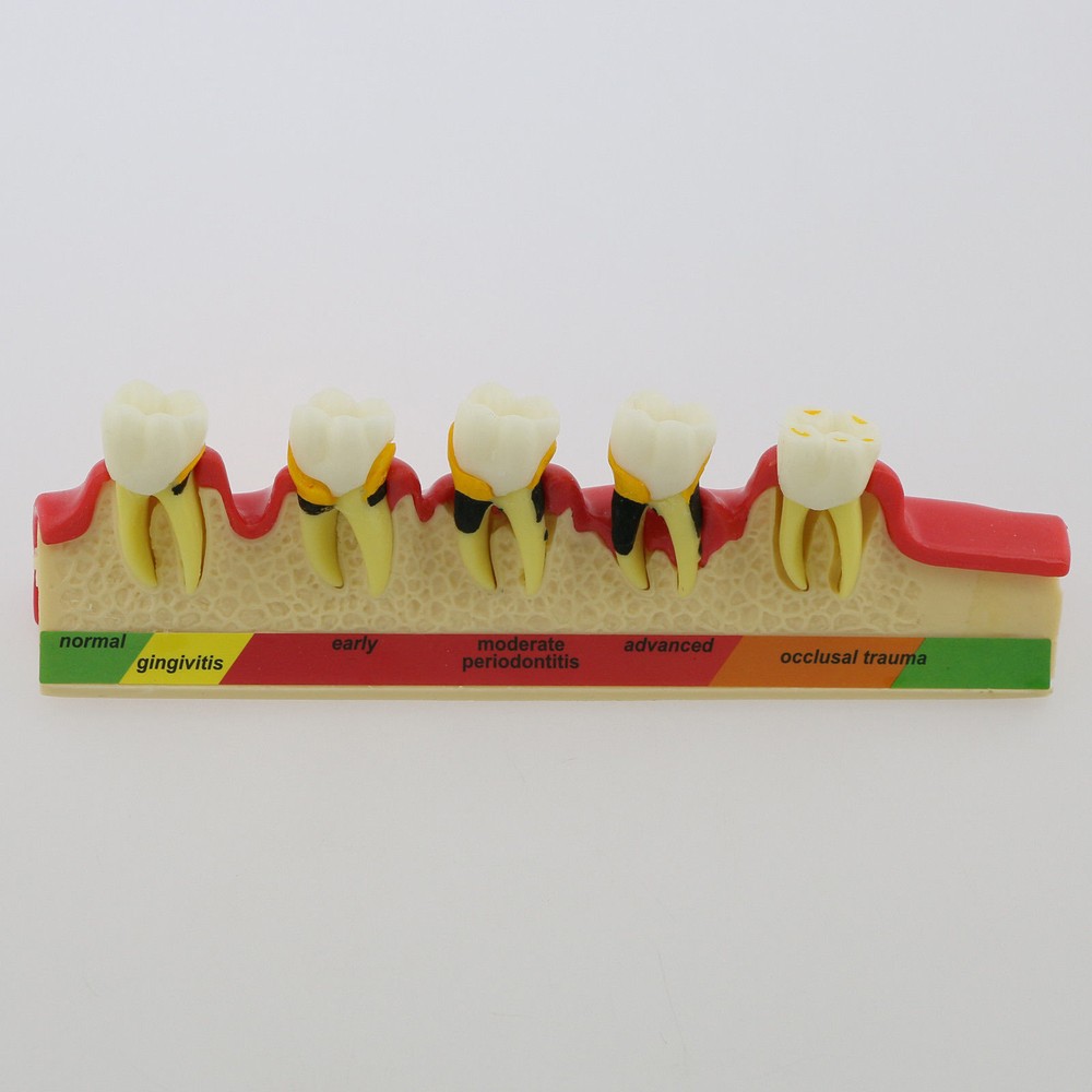 Dental Study Teaching Model Periodontal Disease Assort Teeth Dentoform Typodont