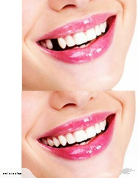 Thermal Fitting Beads, Fix Missing and Broken Teeth, Instant Smile –Pack 12