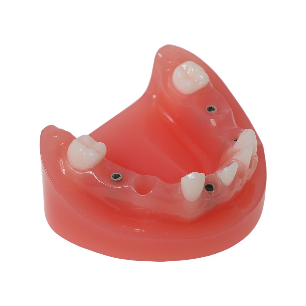 Dental Multi Typodont Teeth Model for Implant Pathological Restoration Practice