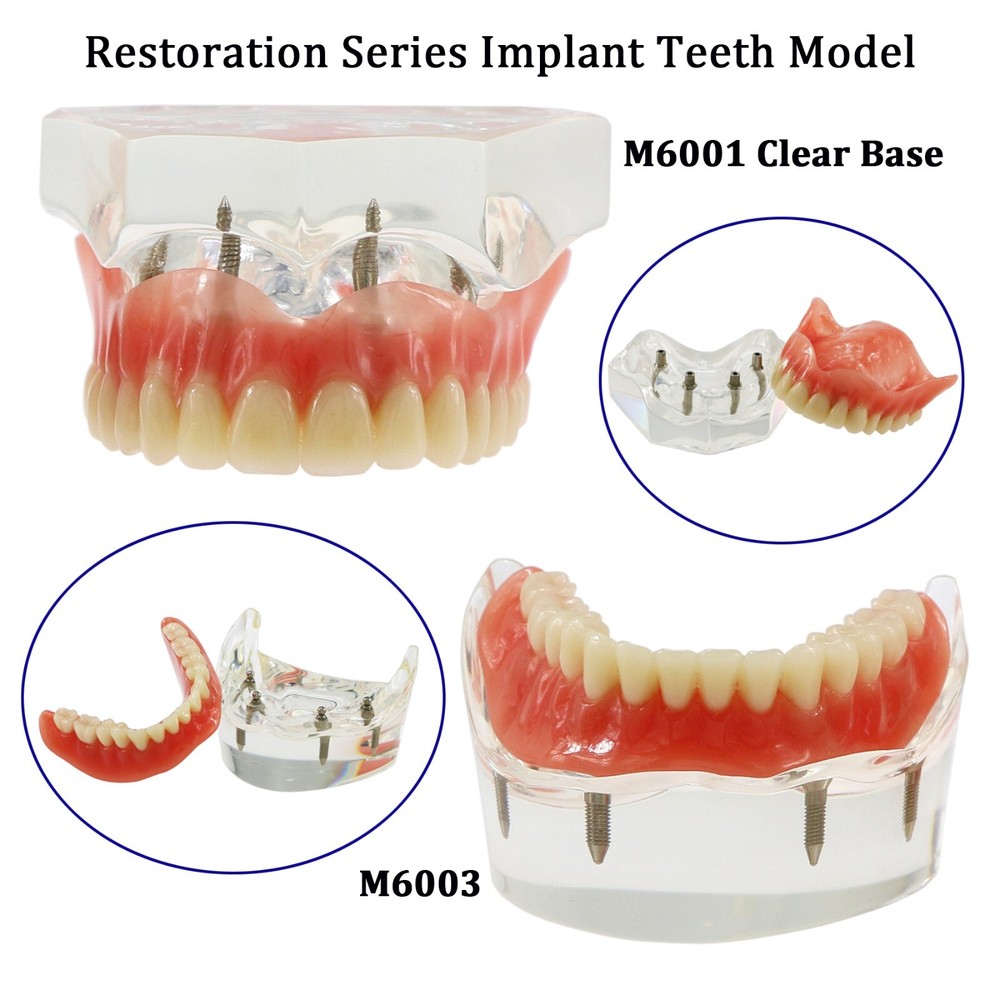 Dental Typodont Implant Overdenture Teeth Model 4 Implants Upper Lower