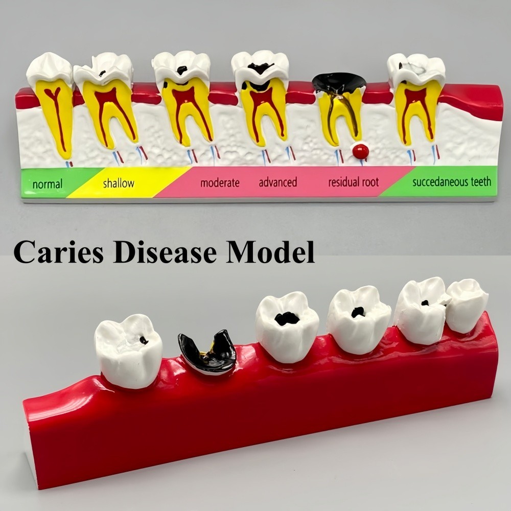 Dental Caries Disease Models Dentoform Typodont Study Teaching Teeth Model Demo