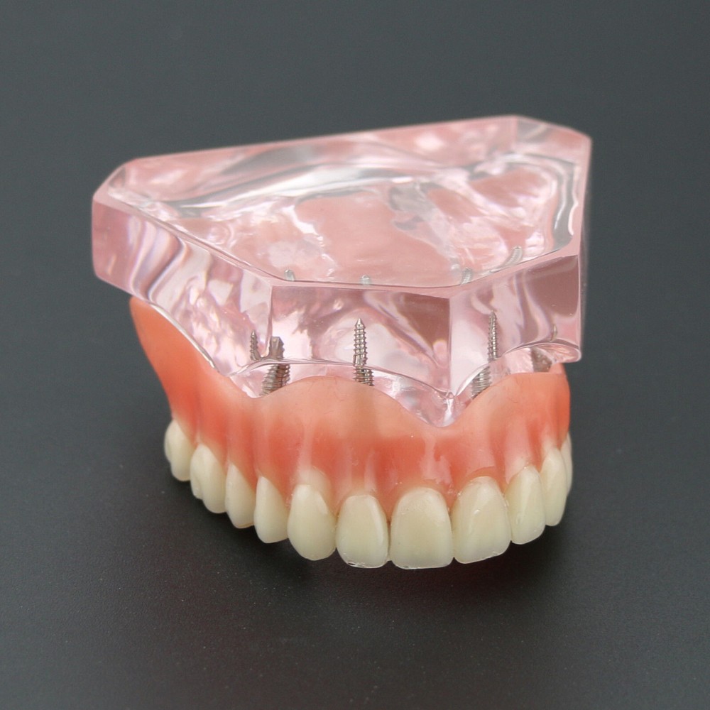 Dental Teeth Model Demo Overdenture Restoration With 4 Implants Upper Maxillary