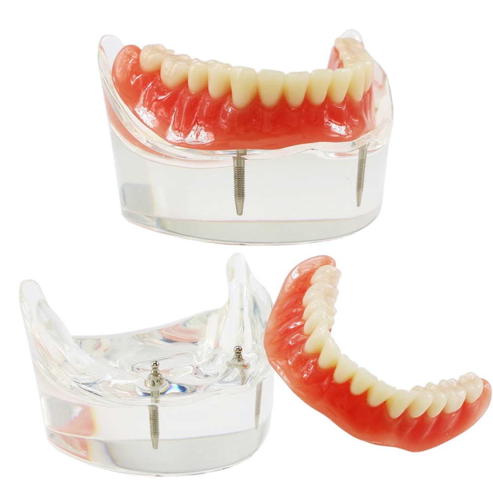 Implant Restoration Teeth Model Mandibular Overdenture with 2 Implants Dental