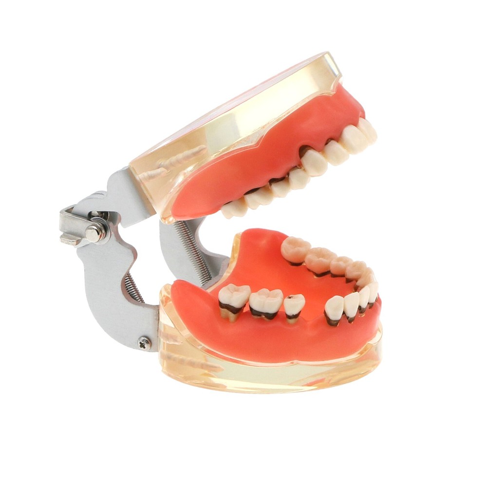 Dental Typodont Teeth Model Pathological Perio Implant Endo Caries Teeth Model