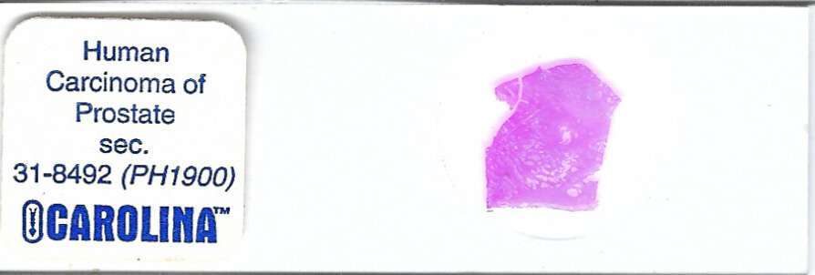 Human Carcinoma of Prostate Pathology Microscope Slide