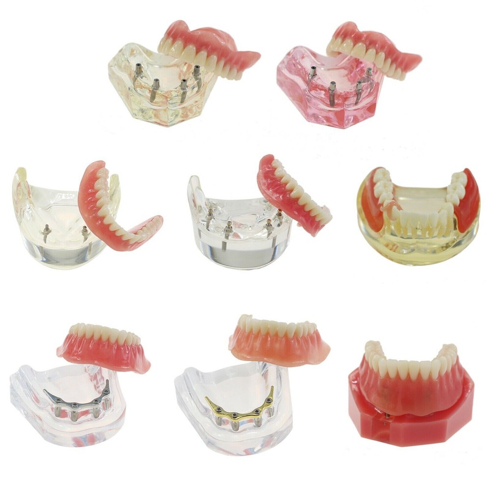 Dental Implant Demo Model Overdenture Restoration 2 4 Implants Upper/Lower