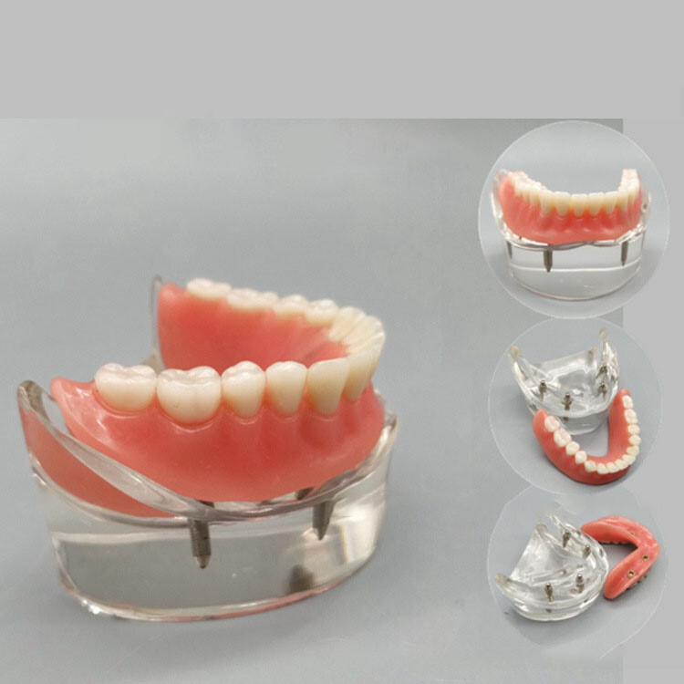 Dental Tooth Model Brushing Training Practice Implant Overdenture Restoration