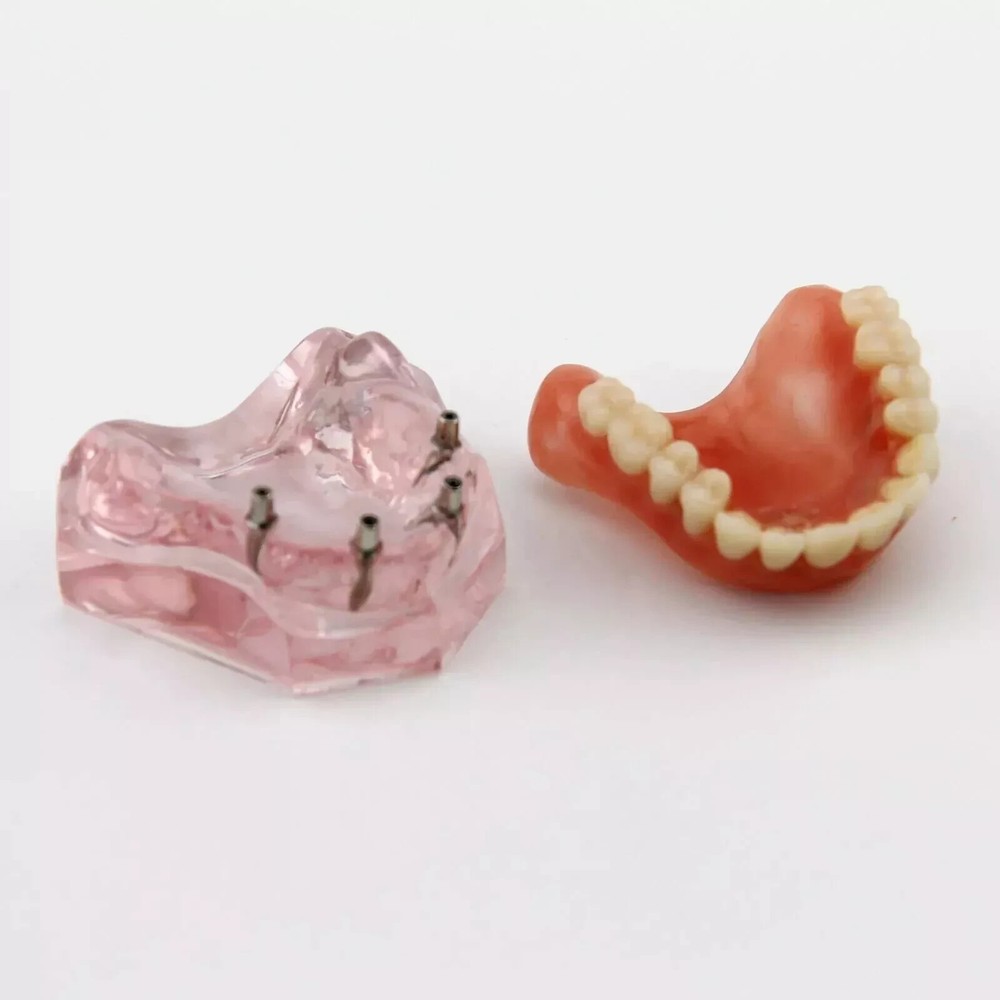 Dental Restoration Teeth Typodont Implants Model Demonstrate Overdenture 3 Model