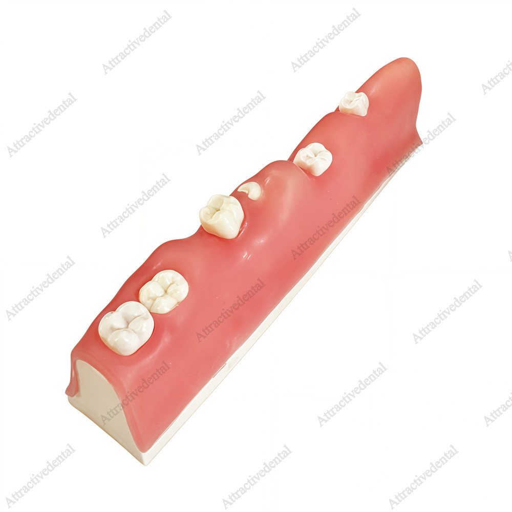 Dental Impacted Tooth Model Wisdom Unerupted Tooth Extraction Practice Training