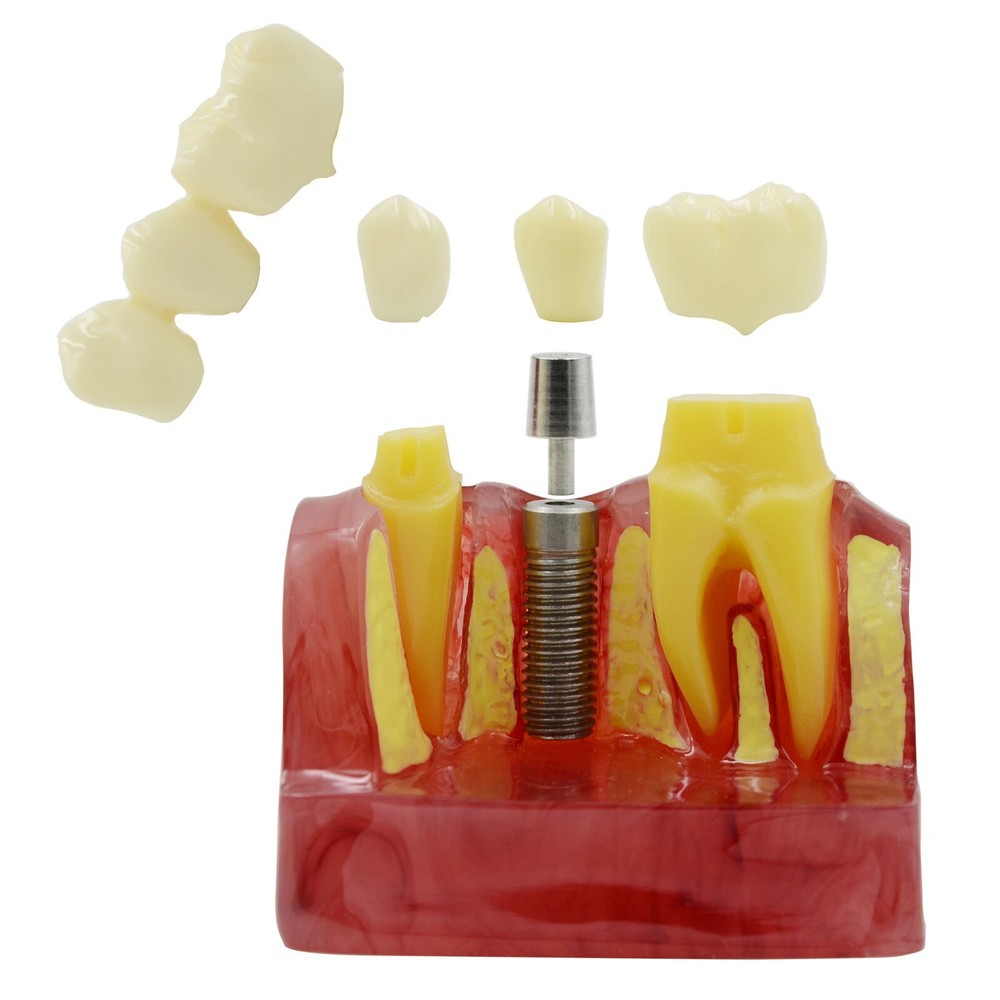 Dental Demonstration Teeth Tooth Model Typodont Implant Analysis Crown Bridge