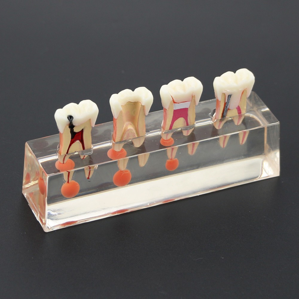 1 Set Dental Teeth Model #4018 01 - 4-Stage Endodontic Treatment Study Model