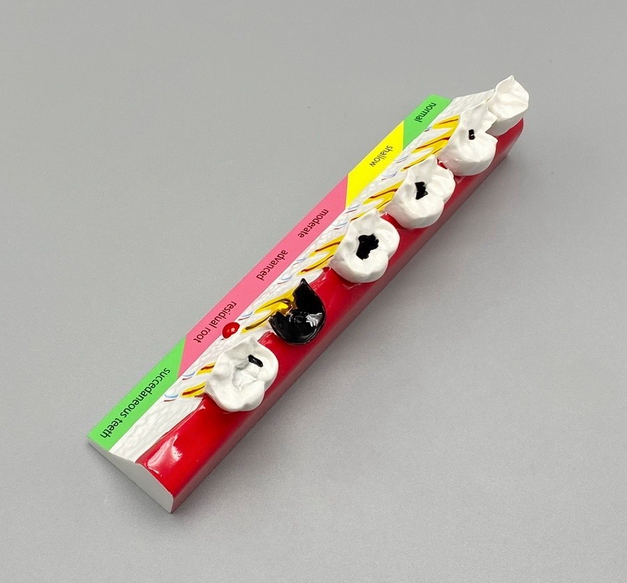 Dental Caries Disease Models Dentoform Typodont Study Teaching Teeth Model Demo