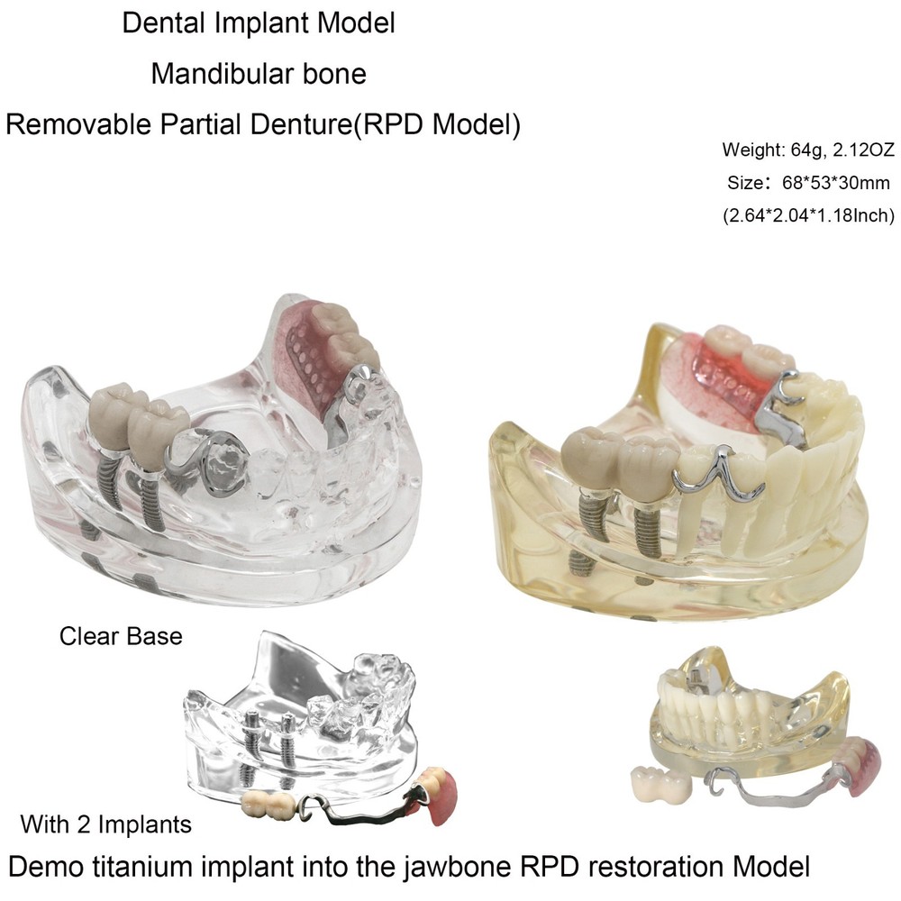 Dental Implant RPD Restoration Model Removable Partial Denture Lower 2 Implants