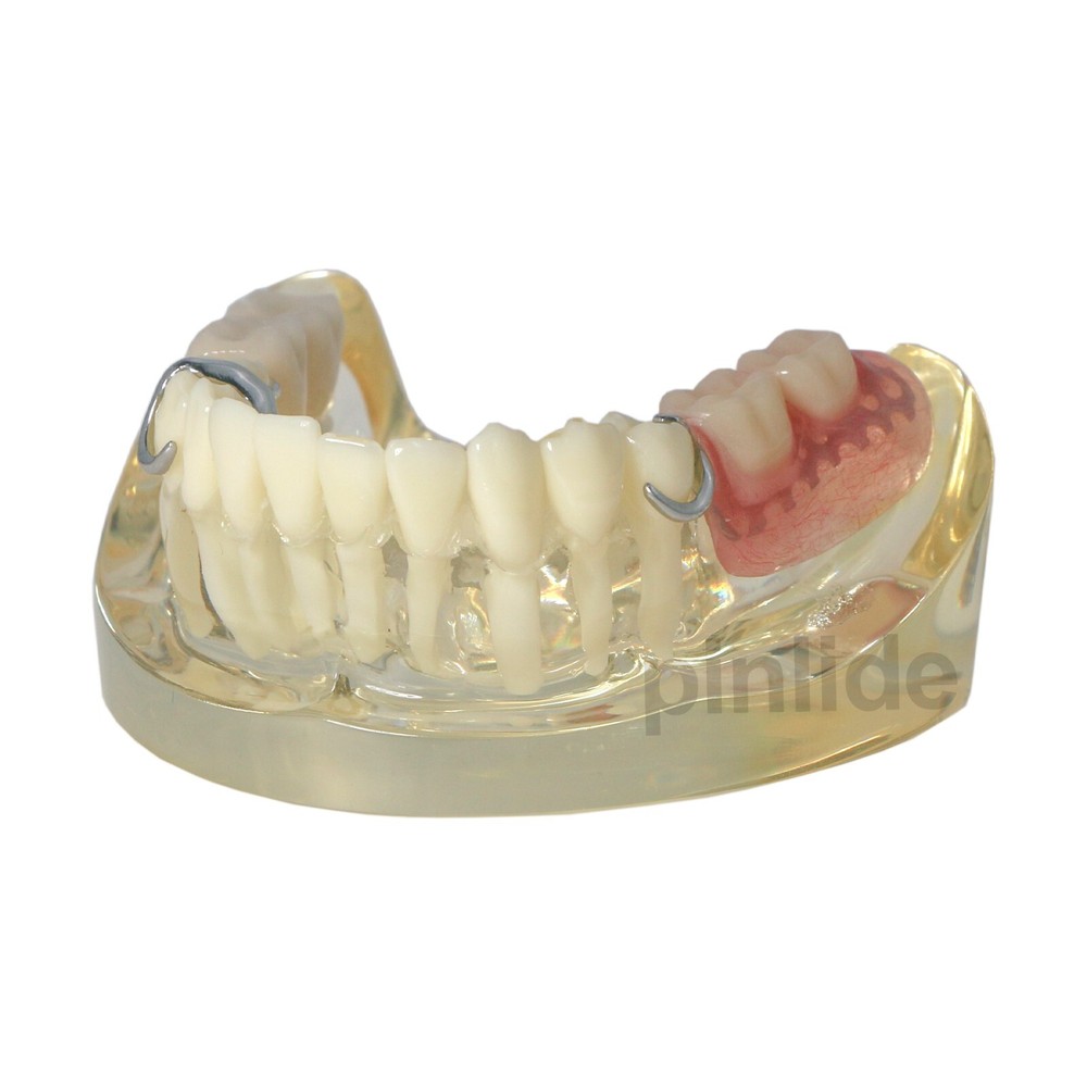 Dental Typodont Restoration Model With 2 Implants Partial Denture Demo M6022