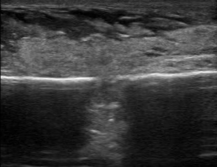 ultrasound broken bone phantom trainer