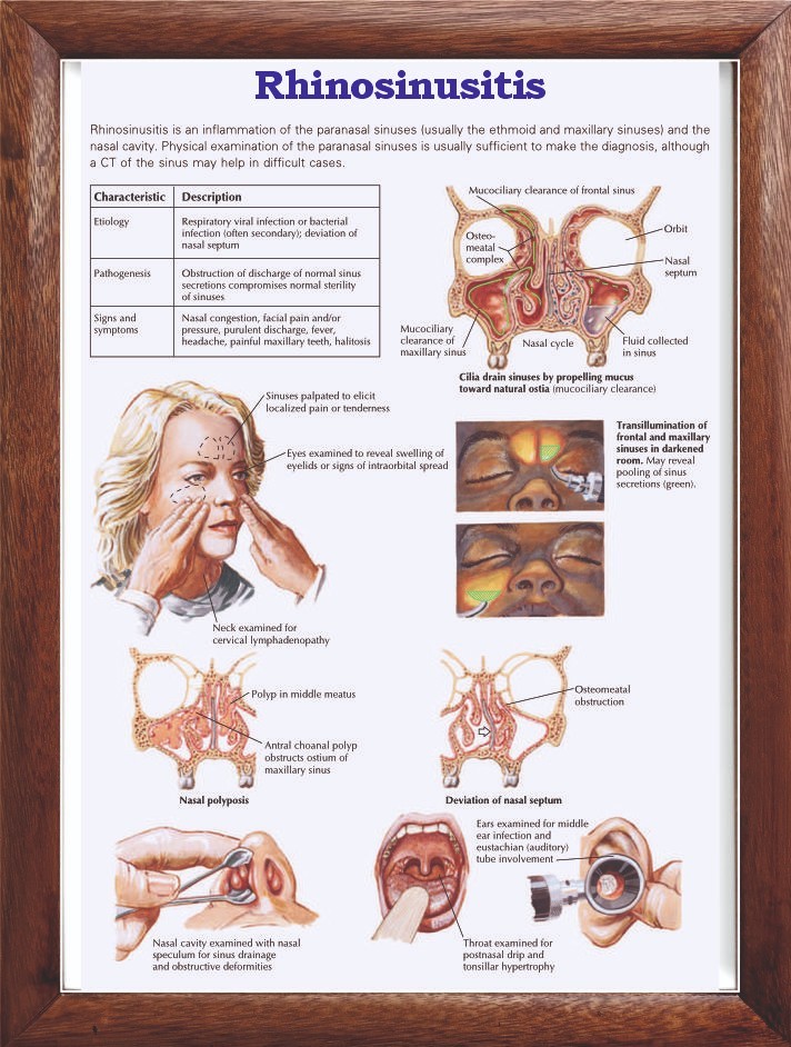 Rhinosinusitis Chart 12x18 inches