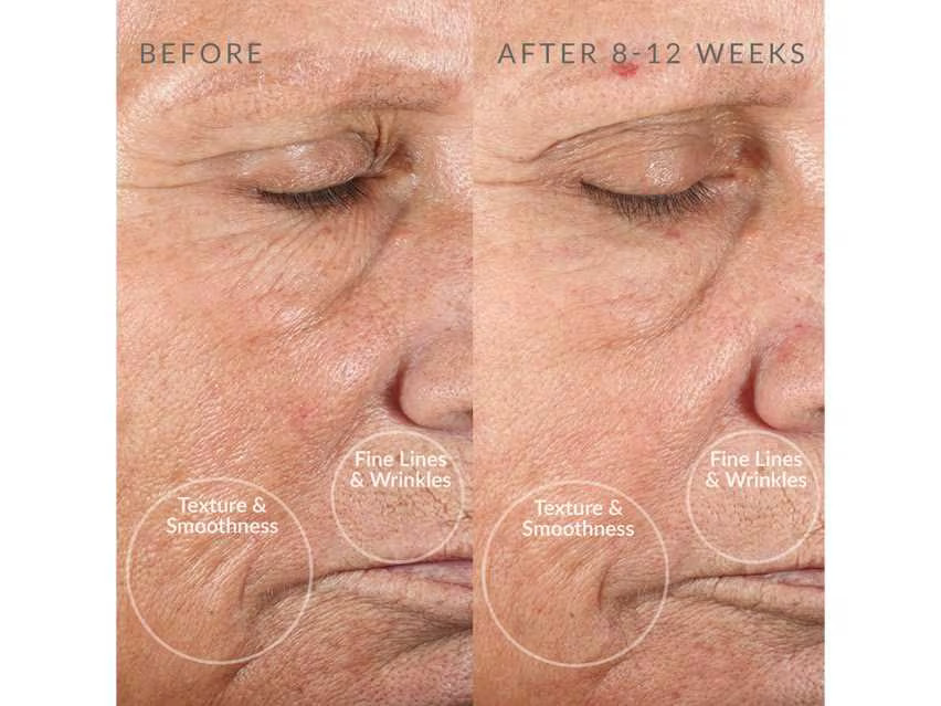 PMD-Personal Microderm Device-LovelySkin|10061